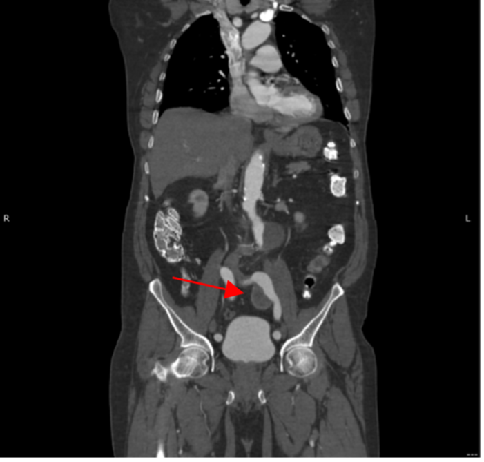 Abdominal Aortic Aneurysm Xray 